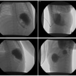 Incarcerated Gastric Volvulus and Splenic Herniation. Upper GI. Unannotated. JETem 2025