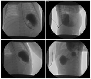 Incarcerated Gastric Volvulus and Splenic Herniation. Upper GI. Unannotated. JETem 2025
