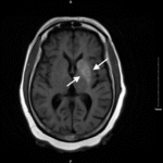 Nonketotic Hyperglycemia Hemichorea. MRI Annotated. JETem 2025