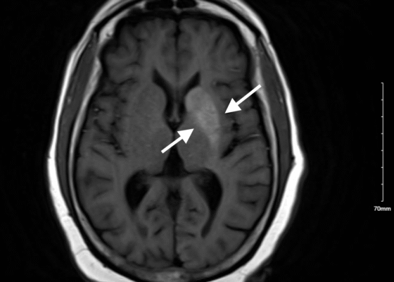 Nonketotic Hyperglycemia Hemichorea. MRI Annotated. JETem 2025