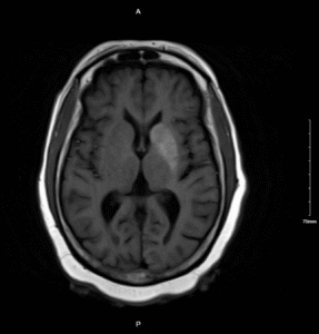 Nonketotic Hyperglycemia Hemichorea. MRI Unnnotated. JETem 2025