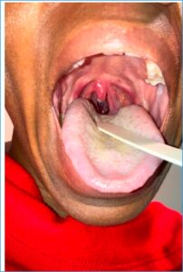 Uvular Necrosis Photo. Unannotated. JETem 2025