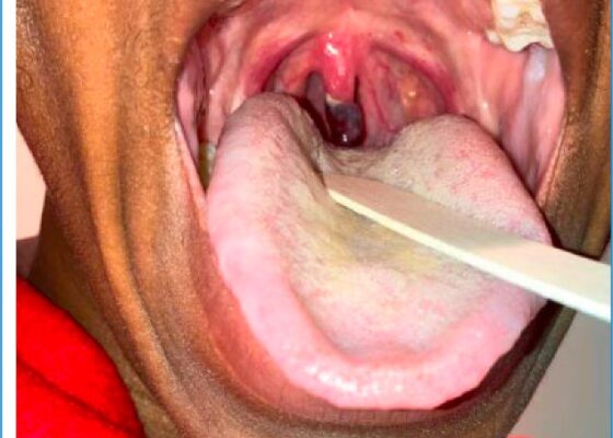 Uvular Necrosis Photo. Unannotated. JETem 2025