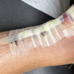 Dermatologic Reaction to Wound Closure Strips and Liquid Adhesive. Photo 1. JETem 2025