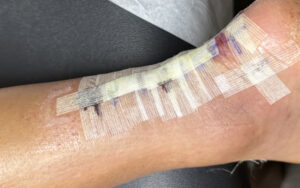 Dermatologic Reaction to Wound Closure Strips and Liquid Adhesive. Photo 1. JETem 2025