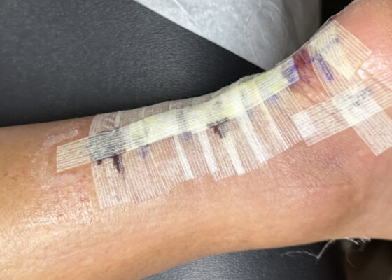 Dermatologic Reaction to Wound Closure Strips and Liquid Adhesive. Photo 1. JETem 2025