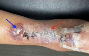 Dermatologic Reaction to Wound Closure Strips and Liquid Adhesive. Photo 2 Annotated. JETem 2025