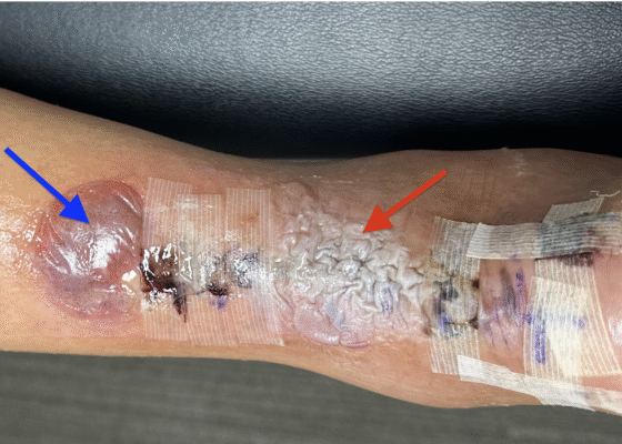 Dermatologic Reaction to Wound Closure Strips and Liquid Adhesive. Photo 2 Annotated. JETem 2025