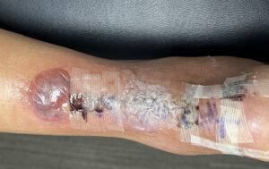 Dermatologic Reaction to Wound Closure Strips and Liquid Adhesive. Photo 2 Unannotated. JETem 2025