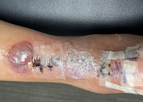 Dermatologic Reaction to Wound Closure Strips and Liquid Adhesive. Photo 2 Unannotated. JETem 2025