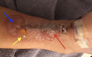Dermatologic Reaction to Wound Closure Strips and Liquid Adhesive. Photo 3 Annotated. JETem 2025
