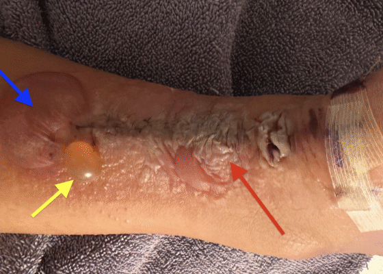 Dermatologic Reaction to Wound Closure Strips and Liquid Adhesive. Photo 3 Annotated. JETem 2025