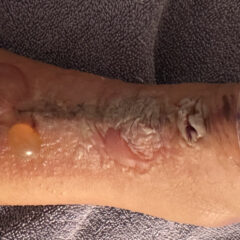 Dermatologic Reaction to Wound Closure Strips and Liquid Adhesive. Photo 3 Unannotated. JETem 2025