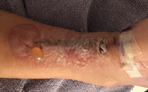 Dermatologic Reaction to Wound Closure Strips and Liquid Adhesive. Photo 3 Unannotated. JETem 2025