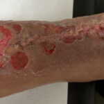 Dermatologic Reaction to Wound Closure Strips and Liquid Adhesive. Photo 4. JETem 2025
