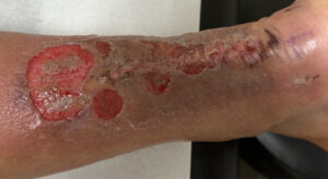 Dermatologic Reaction to Wound Closure Strips and Liquid Adhesive. Photo 4. JETem 2025