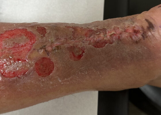 Dermatologic Reaction to Wound Closure Strips and Liquid Adhesive. Photo 4. JETem 2025