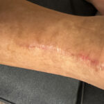 Dermatologic Reaction to Wound Closure Strips and Liquid Adhesive. Photo 5. JETem 2025