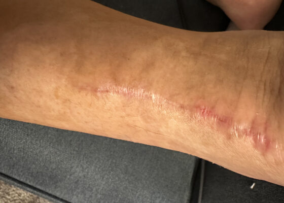 Dermatologic Reaction to Wound Closure Strips and Liquid Adhesive. Photo 5. JETem 2025