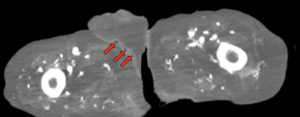 Atypical Presentation of Fourniers Gangrene. CT annotated. JETem 2026