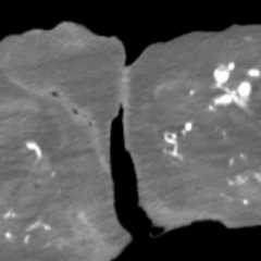 A Case Report of an Atypical Presentation of Fournier’s Gangrene 7 Atypical Presentation of Fourniers Gangrene. CT. JETem 2026