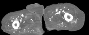 Atypical Presentation of Fourniers Gangrene. CT. JETem 2026