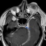 A Case Report of Carotid Cavernous Fistula: A Commonly Missed Diagnosis 5 Carotid Cavernous Fistula MRI 1 annotated blue arrow. JETem 2026
