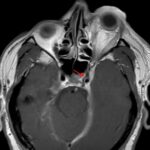 A Case Report of Carotid Cavernous Fistula: A Commonly Missed Diagnosis 4 Carotid Cavernous Fistula MRI 1 annotated red arrow. JETem 2026