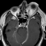 A Case Report of Carotid Cavernous Fistula: A Commonly Missed Diagnosis 2 Carotid Cavernous Fistula MRI 1. JETem 2026