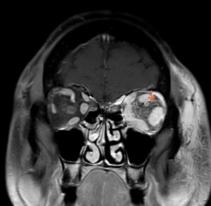 Carotid Cavernous Fistula MRI 2 annotated. JETem 2026