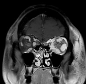 Carotid Cavernous Fistula MRI 2. JETem 2026