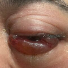 Carotid Cavernous Fistula Photograph. JETem 2026