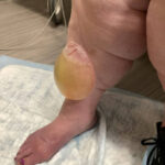 Edema Bulla. Photo 1. JETem 2026