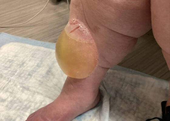 Edema Bulla. Photo 1. JETem 2026