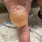 Edema Bulla. Photo 2. JETem 2026