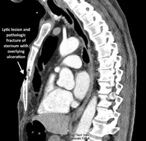 Open Chest Wound. CT annotated. JETem 2026