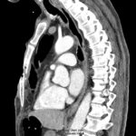 Open Chest Wound with Sternal Fracture in the Emergency Department, a Case Report 1 Open Chest Wound. CT. JETem 2026