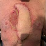 Open Chest Wound with Sternal Fracture in the Emergency Department, a Case Report 5 Open Chest Wound. Photo Post Surgery annotated. JETem 2026