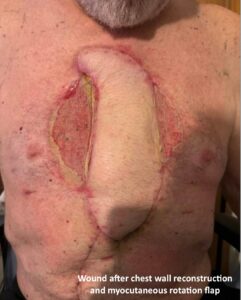 Open Chest Wound. Photo Post Surgery annotated. JETem 2026