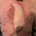 Open Chest Wound with Sternal Fracture in the Emergency Department, a Case Report 2 Open Chest Wound. Photo Post Surgery. JETem 2026