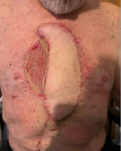 Open Chest Wound. Photo Post Surgery. JETem 2026