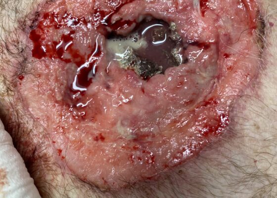 Open Chest Wound. Photo. JETem 2026