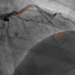 A Case Report of a 36-year-old Male Diagnosed with a Spontaneous Coronary Artery Dissection 3 SCAD. Angiography Annotated. JETem 2026