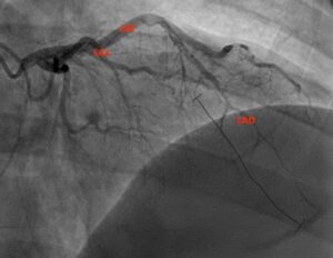 SCAD. Angiography Annotated. JETem 2026