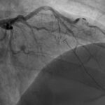 A Case Report of a 36-year-old Male Diagnosed with a Spontaneous Coronary Artery Dissection 2 SCAD. Angiography. JETem 2026