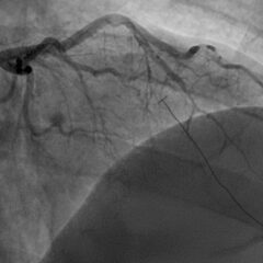 A Case Report of a 36-year-old Male Diagnosed with a Spontaneous Coronary Artery Dissection 2 SCAD. Angiography. JETem 2026