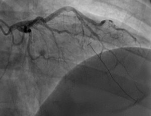 SCAD. Angiography. JETem 2026