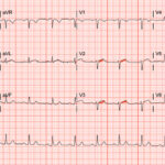 A Case Report of a 36-year-old Male Diagnosed with a Spontaneous Coronary Artery Dissection 4 SCAD. ECG. Annotated. JETem 2026