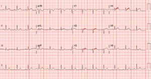 SCAD. ECG. Annotated. JETem 2026
