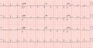 SCAD. ECG. JETem 2026